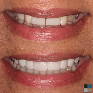 Close up of smile before and after fixing gap between two front teeth