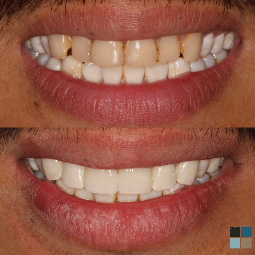 Close up of teeth before and after whitening