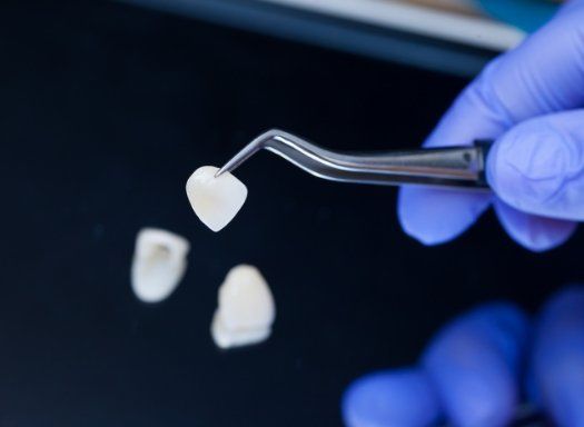 Dentist holding a veneer with tweezers