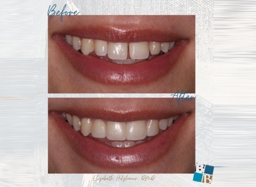 Close up of smile before and after fixing small gap between two front teeth