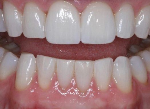 Close up of smile after gum recontouring