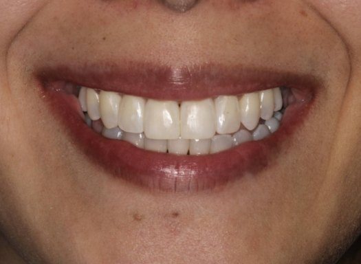 Close up of dental patient smiling after cosmetic dentistry