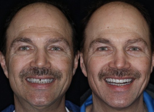 Man grinning before and after smile makeover