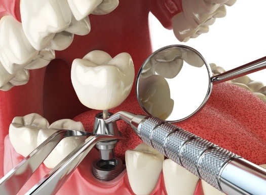 Illustrated dental implant being placed in lower jaw