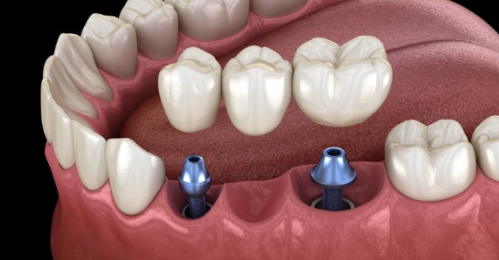 Dental bridge being placed onto two dental implants