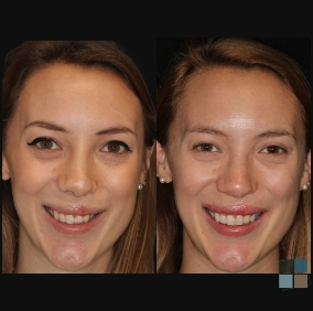 Woman smiling before and after cosmetic dentistry