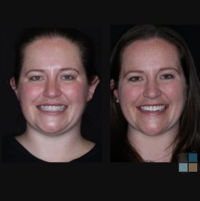 Man smiling before and after orthodontic treatment