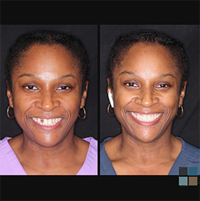 Man smiling before and after dental work