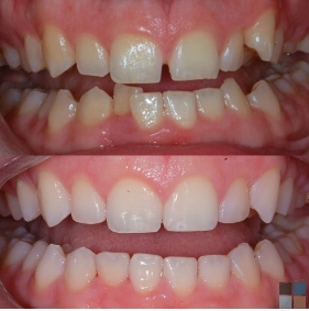 Close up of teeth before and after orthodontic treatment