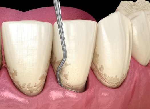 Illustrated dental tool removing plaque buildup from teeth