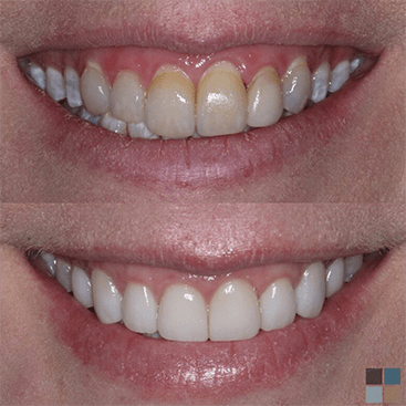 Close up of smile before and after teeth whitening