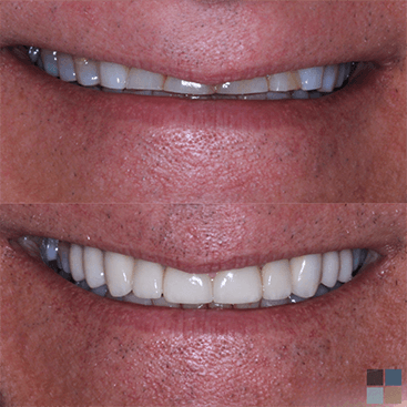 Close up of teeth before and after whitening