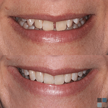 Close up of smile before and after cosmetic dentistry