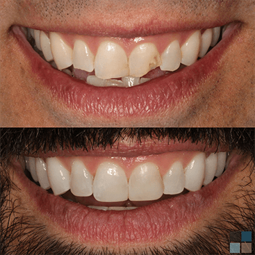 Close up of smile before and after fixing chipped teeth