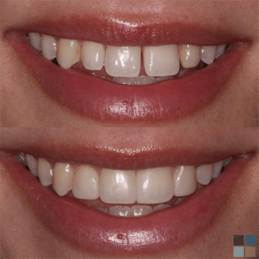 Close up of smile before and after correcting slightly gapped teeth