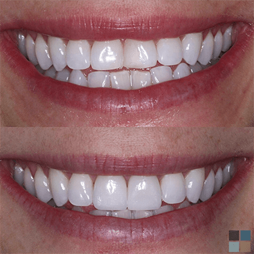Close up of smile before and after correcting slightly crooked teeth