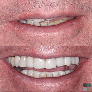 Close up of smile before and after restoring damaged teeth