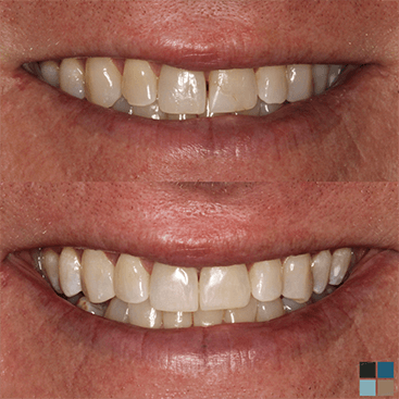 Close up of smile before and after cosmetic dental work