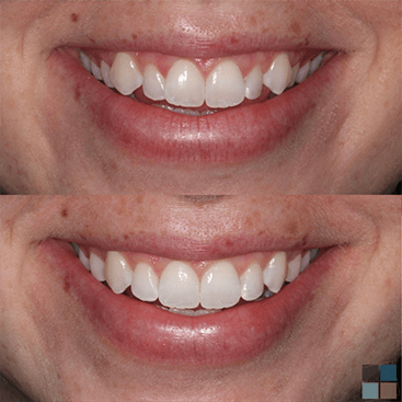 Close up of smile before and after correcting slightly misshapen teeth