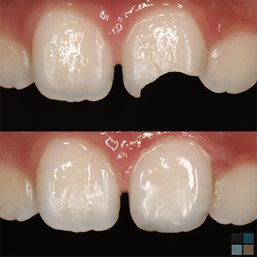 Close up of chipped front tooth before and after dental treatment