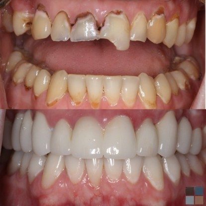 photos of smile before and after dental work