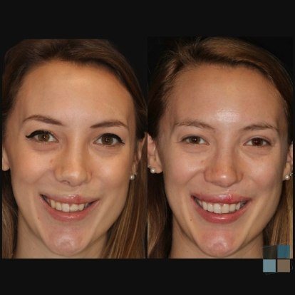 photos of smile before and after dental work