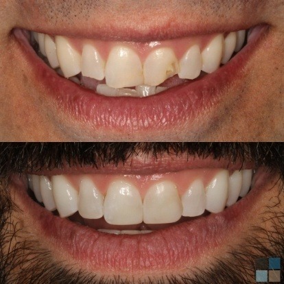 photos of smile before and after dental work