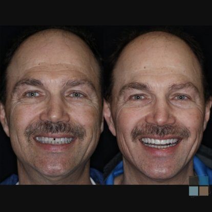 photos of smile before and after dental work