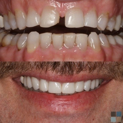 photos of smile before and after dental work