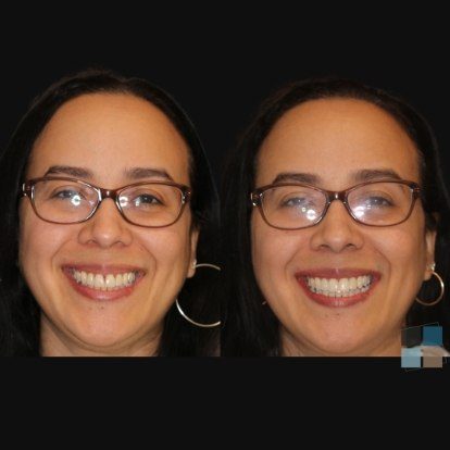 photos of smile before and after dental work