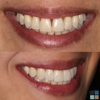 photos of smile before and after dental work