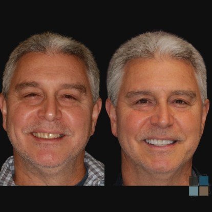 photos of smile before and after dental work