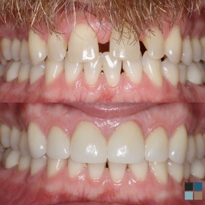 photos of smile before and after dental work