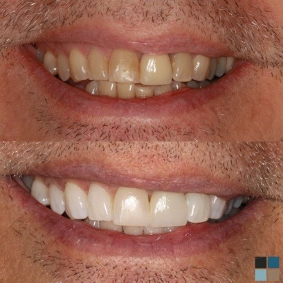 photos of smile before and after dental work