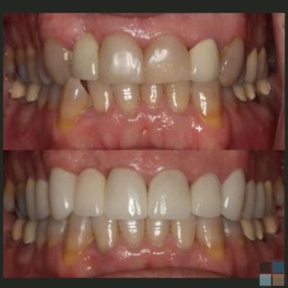 photos of smile before and after dental work