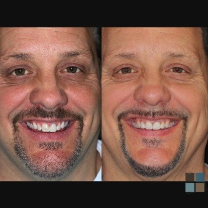 photos of smile before and after dental work