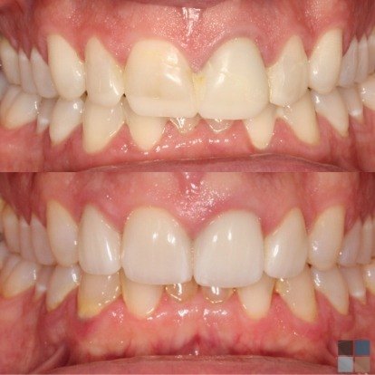 photos of smile before and after dental work