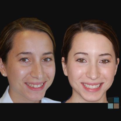 photos of smile before and after dental work