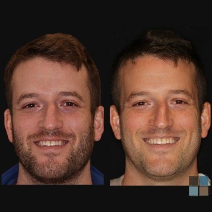 photos of smile before and after dental work