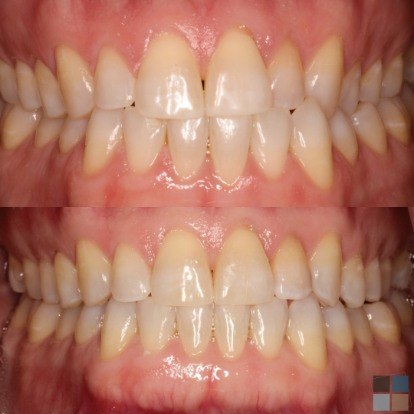 photos of smile before and after dental work