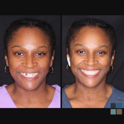 photos of smile before and after dental work