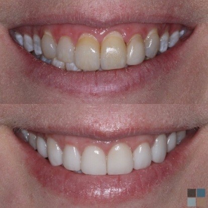 photos of smile before and after dental work