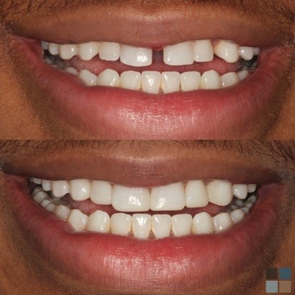 photos of smile before and after dental work