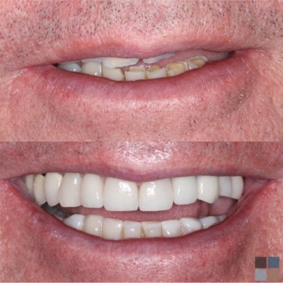 photos of smile before and after dental work