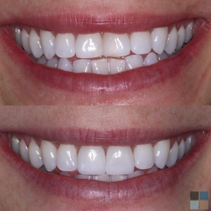 photos of smile before and after dental work