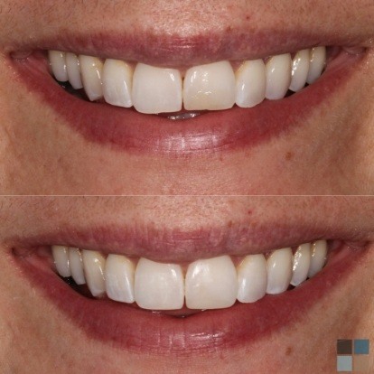 photos of smile before and after dental work