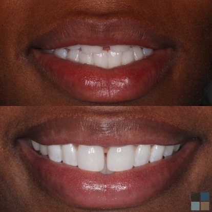 photos of smile before and after dental work