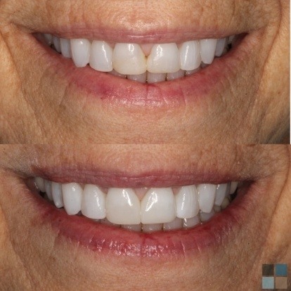 photos of smile before and after dental work