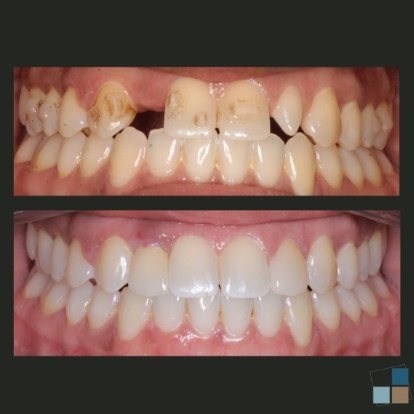 photos of smile before and after dental work