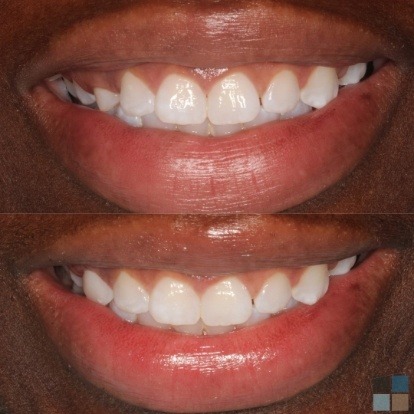 photos of smile before and after dental work